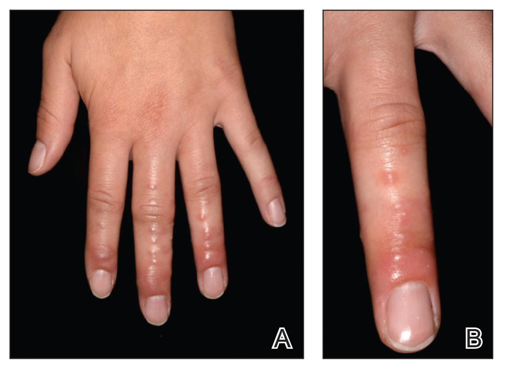 Granulomatous Reaction After Cholla Cactus Spine Injury MDedge
