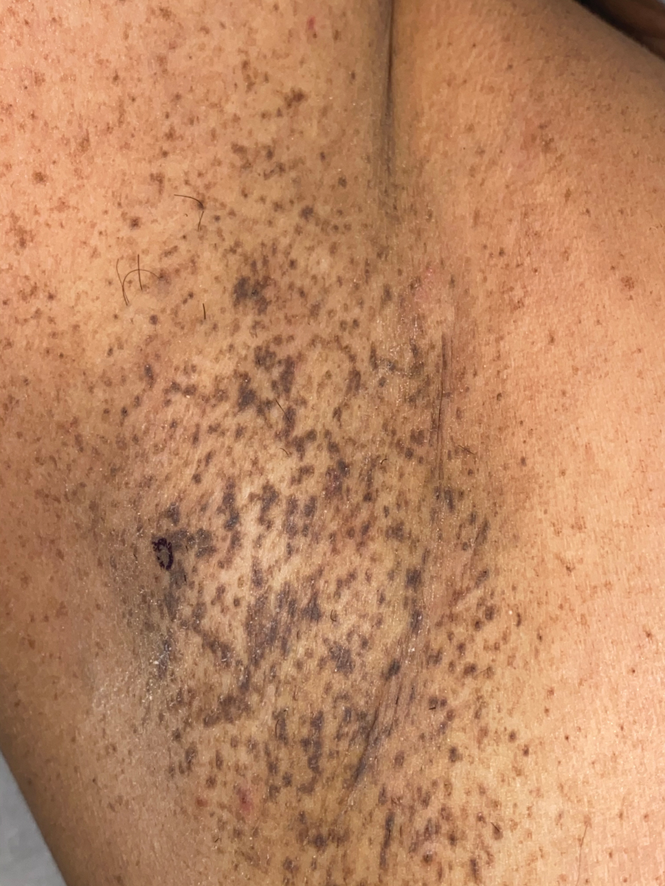 Progressive Axillary Hyperpigmentation MDedge Dermatology