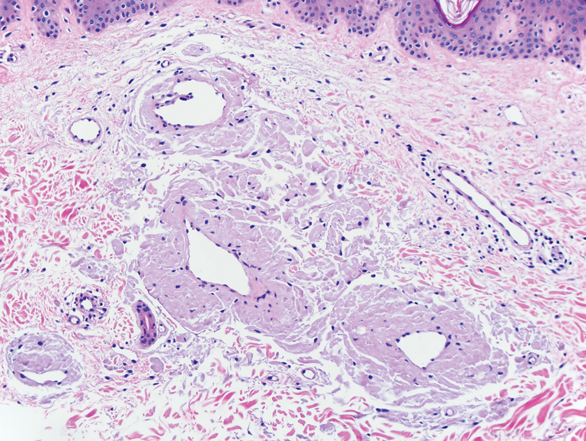 EnfuvirtideInduced Cutaneous Amyloidosis MDedge Dermatology