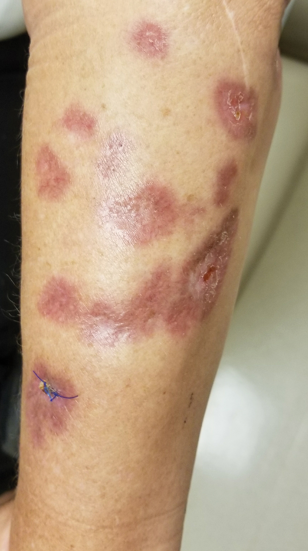 Annular Atrophic Plaques on the Forearm MDedge Dermatology