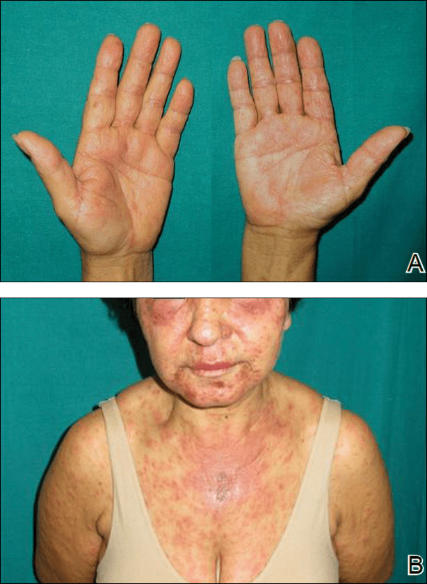 DRESS Syndrome Induced by Telaprevir A Potentially Fatal Adverse Event