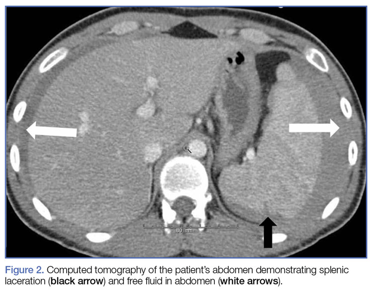 Concept Map For Traumatic Splenic Laceration Nontraumatic Splenic Rupture MDedge Emergency Medicine