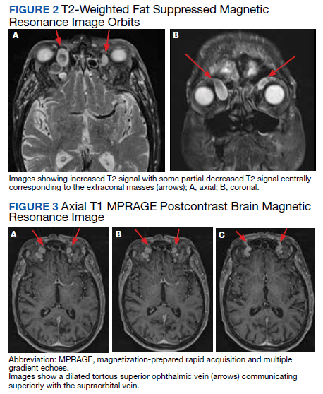 Orbital Varix Masquerading as an Intraorbital Lymphoma