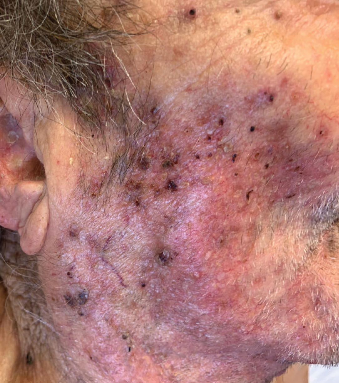 Vegetative Plaques on the Face MDedge Dermatology