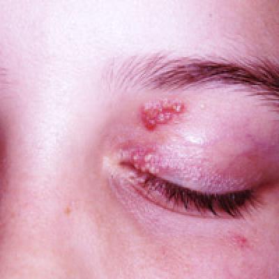 Recurrent "Rash" On Eyelid Cause For Concern? | Clinician Reviews