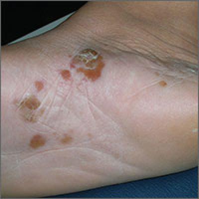 Itchy Blisters On Feet | Mdedge Family Medicine