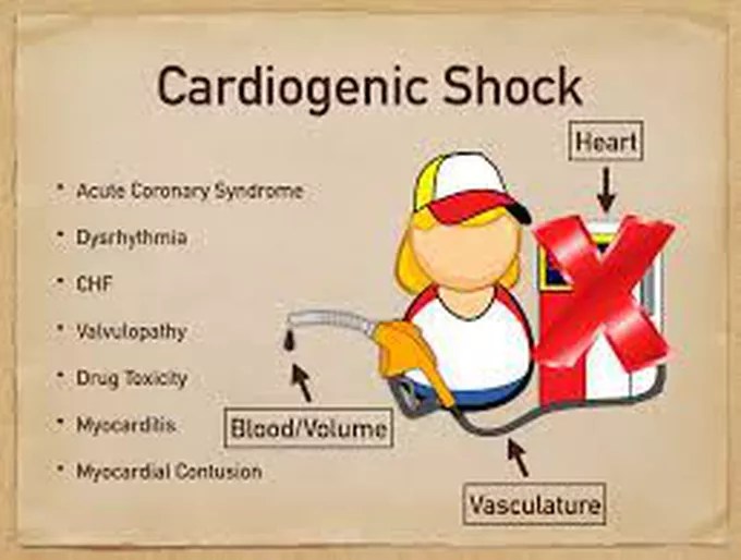 Treatment for cardiogenic shock MEDizzy
