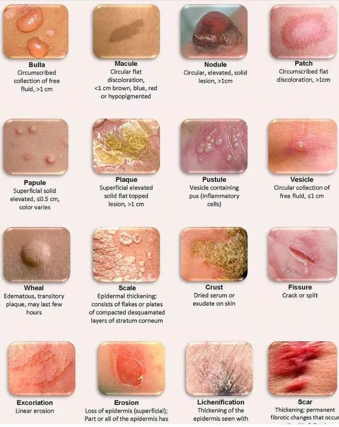 Types of skin lesions MEDizzy