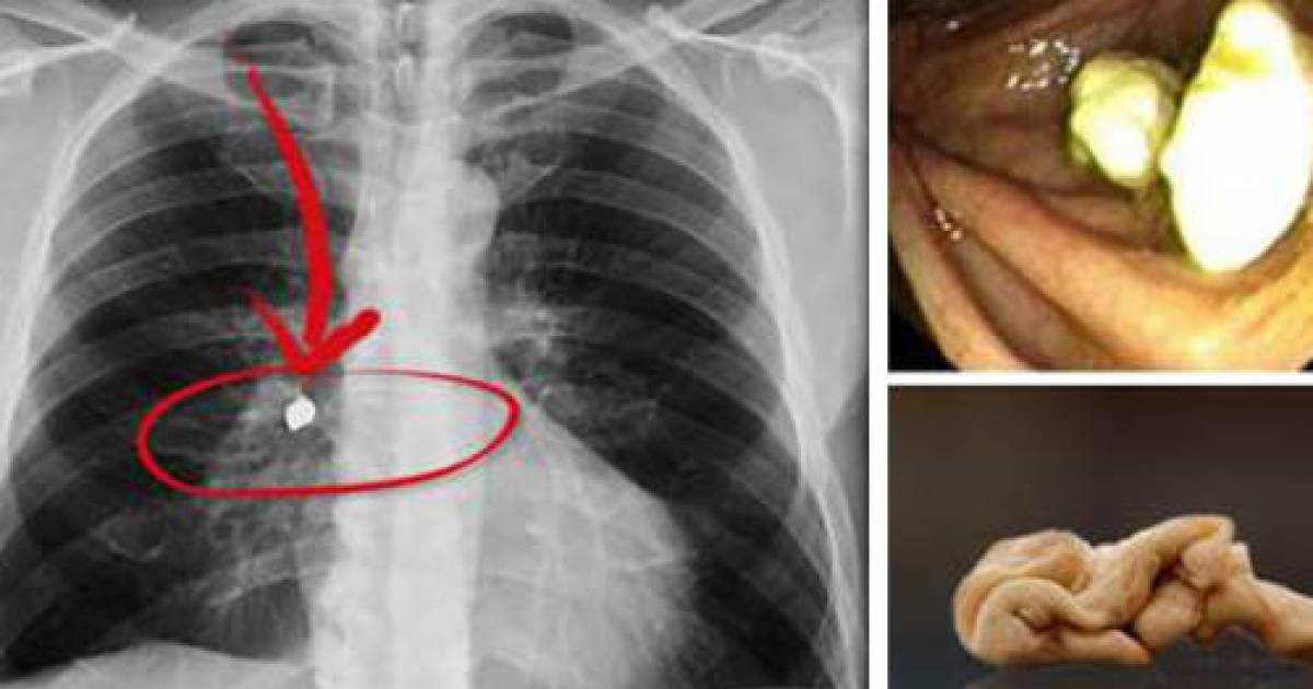 The Dangers Of Swallowing Gum Moetron
