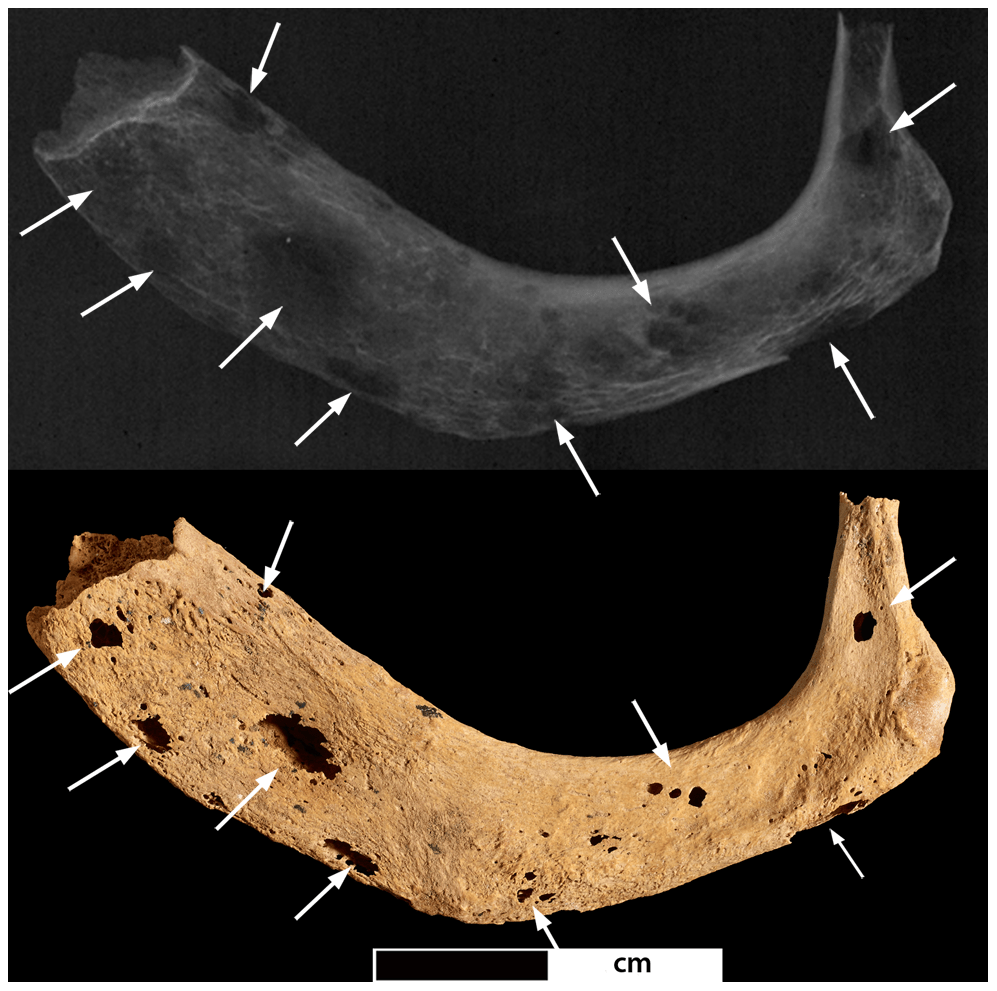 A photo and radiograph of the left first rib. Arrows indicate the locations of lesions.