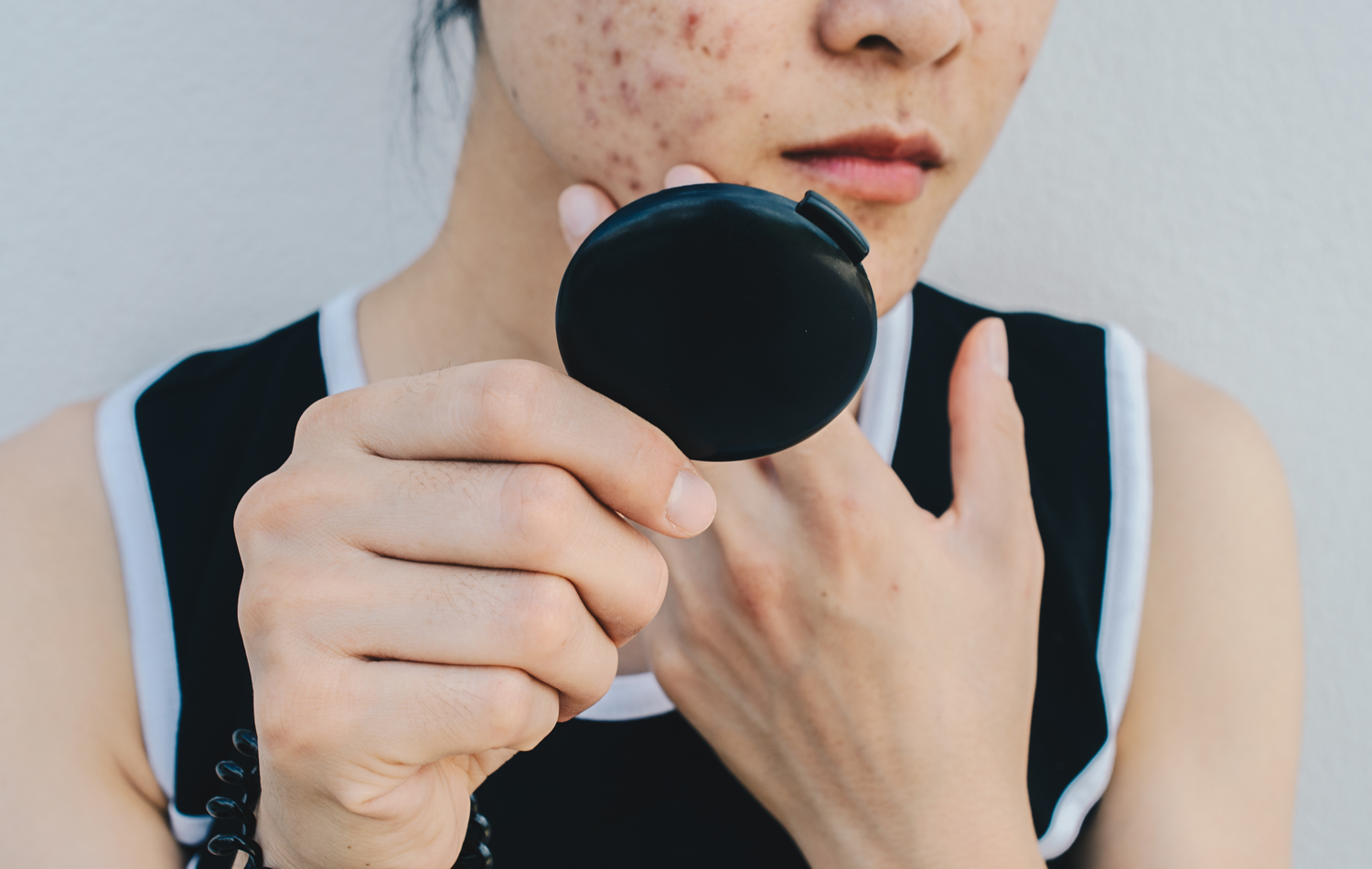 Can dry skin cause acne? We ask a dermatologist to explain My