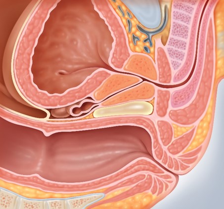 An illustration of the SpaceOAR gel (yellow) after injection above the colon.