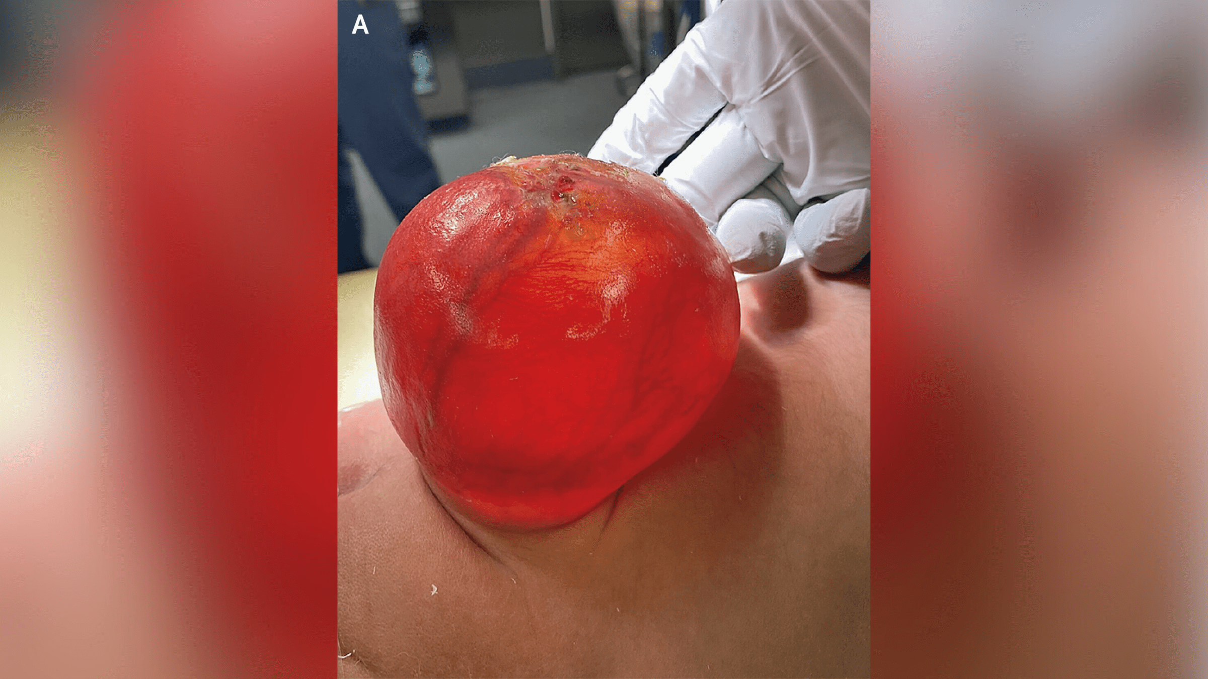 A close-up picture of the &ldquo;red balloon&rdquo;-like sac structure that was protruding from the newborn&rsquo;s spine.