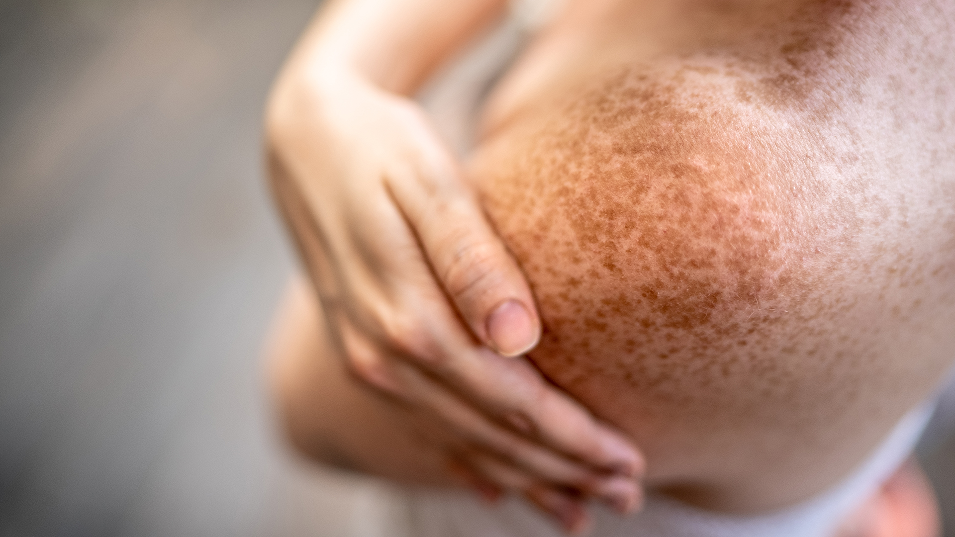 Close up of a person�s hand wrapped around their freckled shoulder.