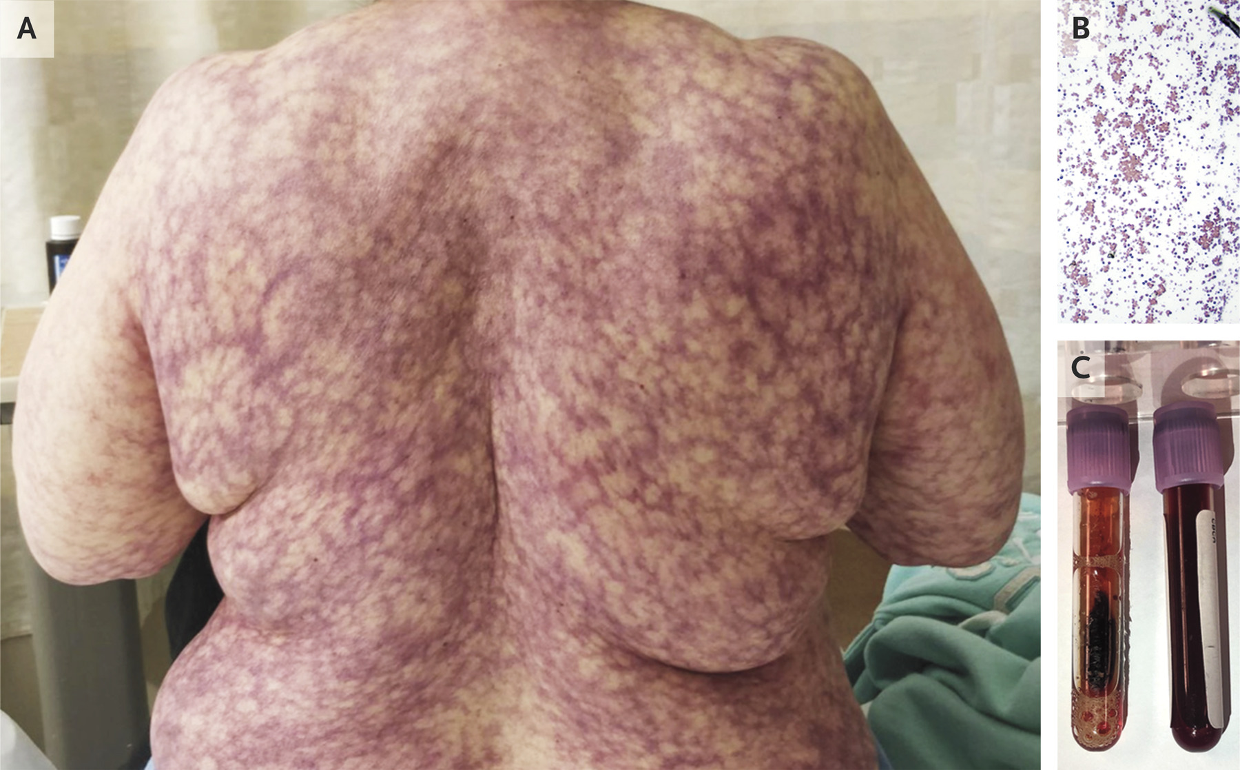 Photo of a rash on a woman�s back, images of blood cells and vials of the patient�s blood