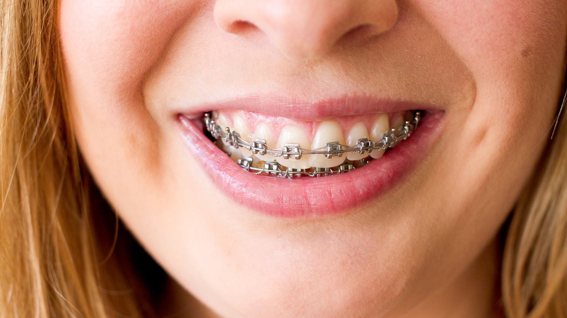 Can you use an electric toothbrush with braces: image shows mouth with bracecs