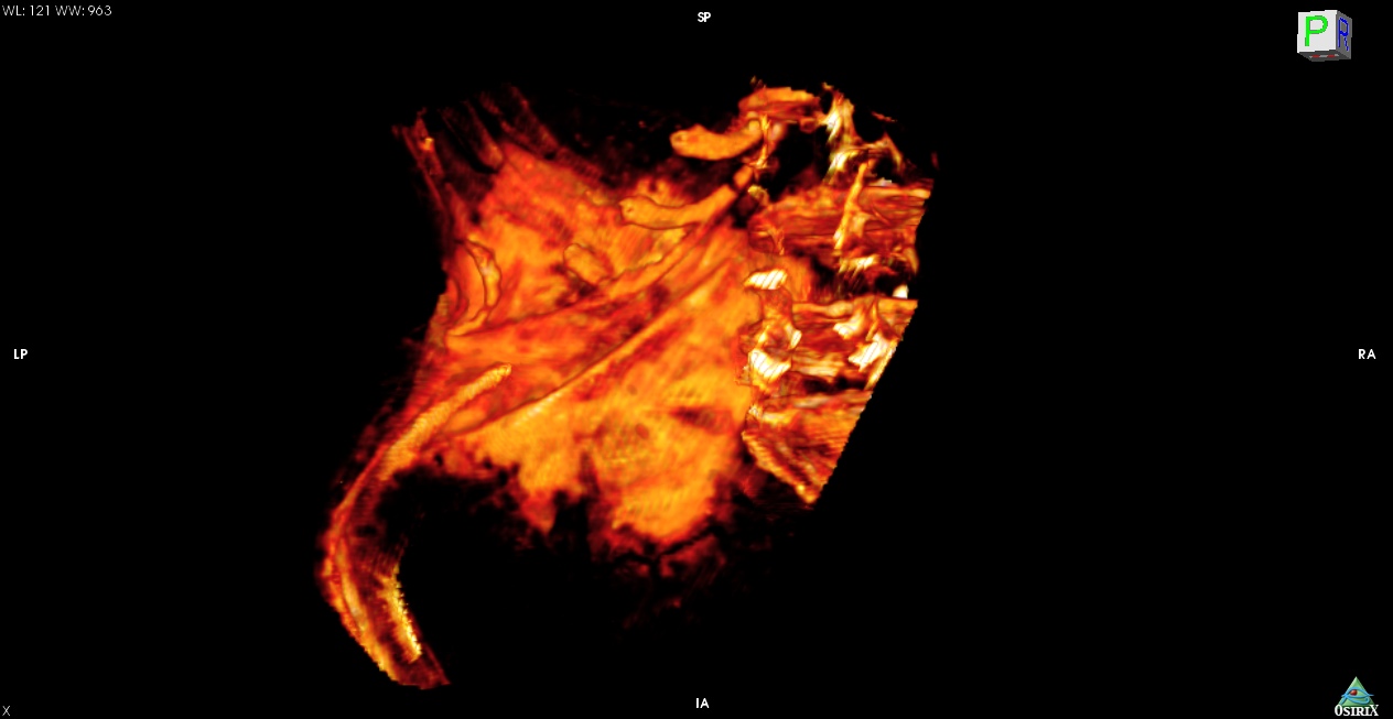 CT scan showing abdominal plaque on a 1,700-year-old mummy.