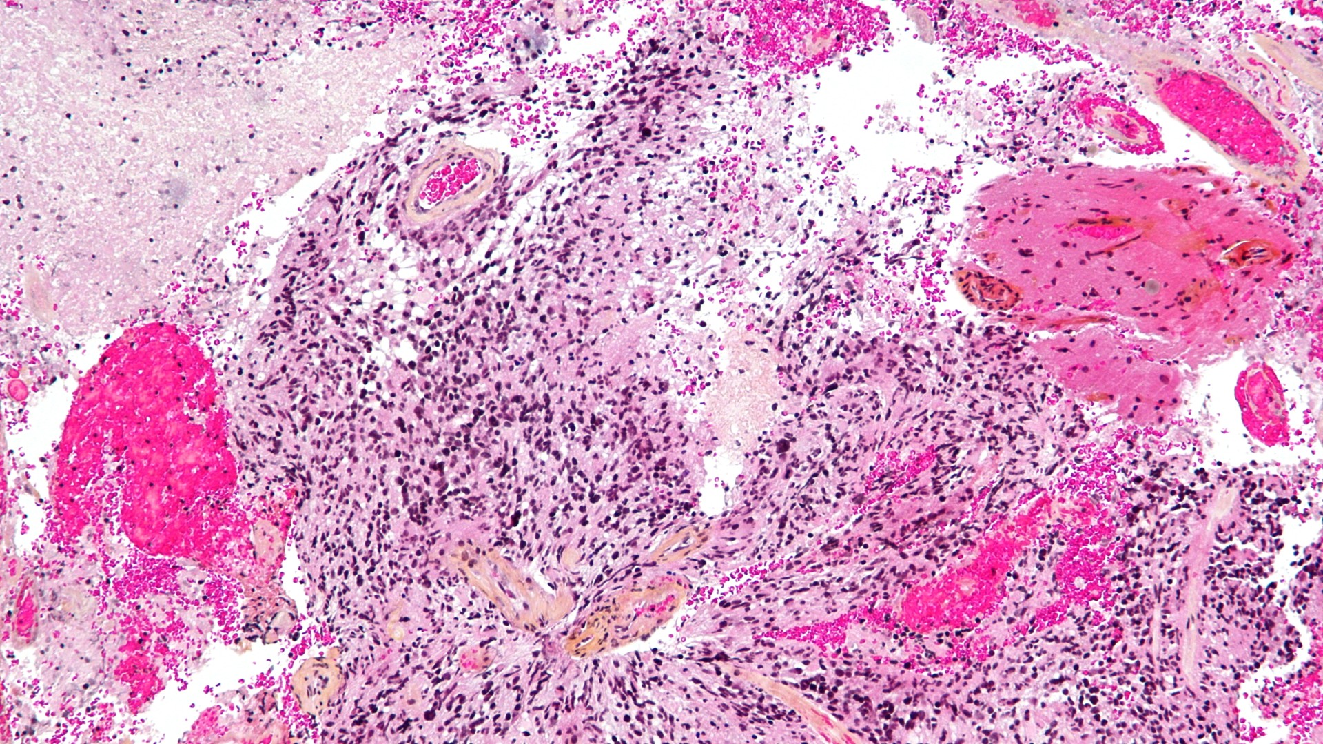 Multi-colored microscope image of glioblastoma up close under the microscope. There&rsquo;s lots of black spots dotted around the image, with larger, circular hot pink patches, as well as lighter pink and light yellow patches of different shapes/sizes. White gaps are seen between them.