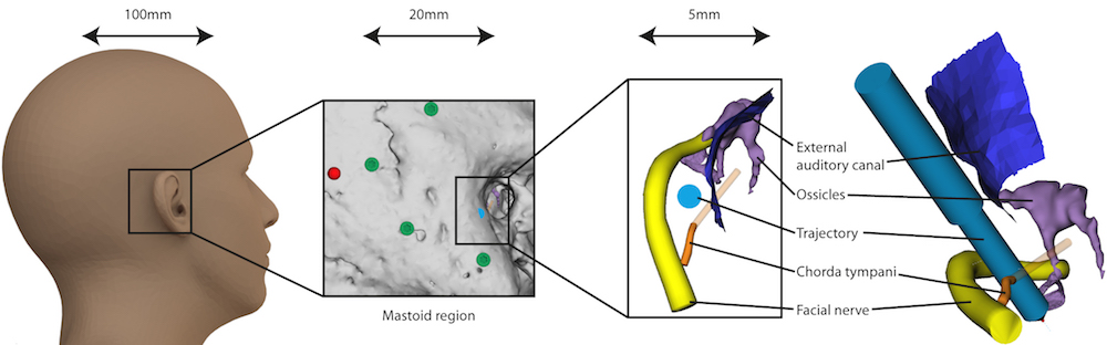 Cochlear implantation is an extremely delicate surgery. The surgical robot (in teal) must work within the tiny space between the facial and taste nerve.