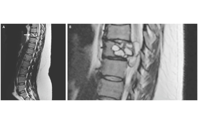 vertebral hydatidosis, echinococcus granulosus, cystic echinococcosis