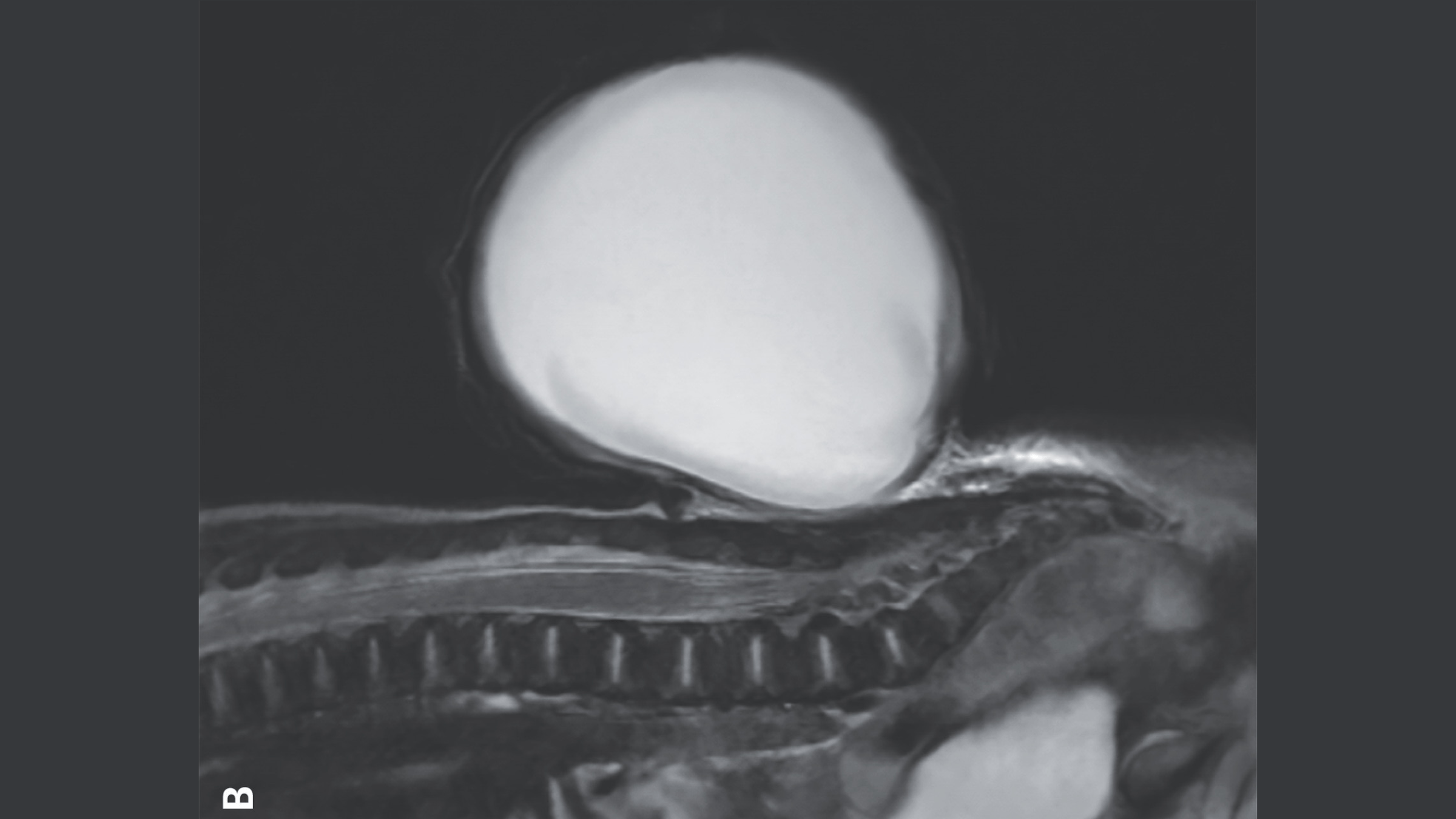A black-and-white MRI image of the sac that was protruding from the newborn�s spine.