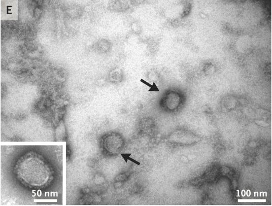 Image showing the Alongshan virus particles (arrows).