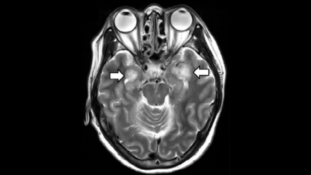 Woman with COVID19 developed a rare brain condition. Doctors suspect a