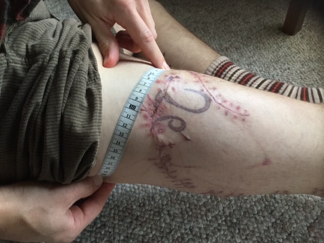 Joseph Tanner’s leg after the attack.