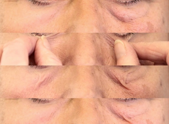 This series of images shows a &ldquo;tenting test&rdquo; performed on the skin. The skin is briefly gently pinched, and then allowed to recoil to its original position.