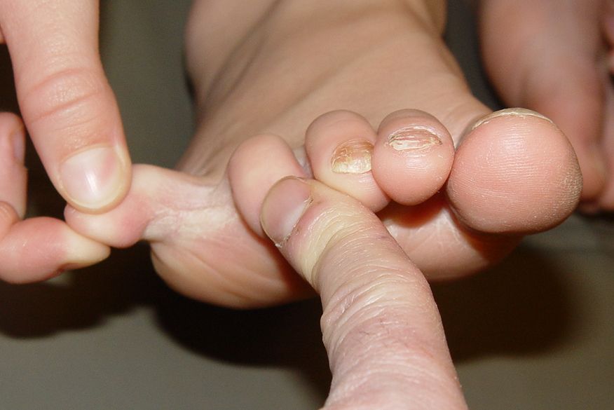 Nail Fungus Symptoms and Treatment Live Science