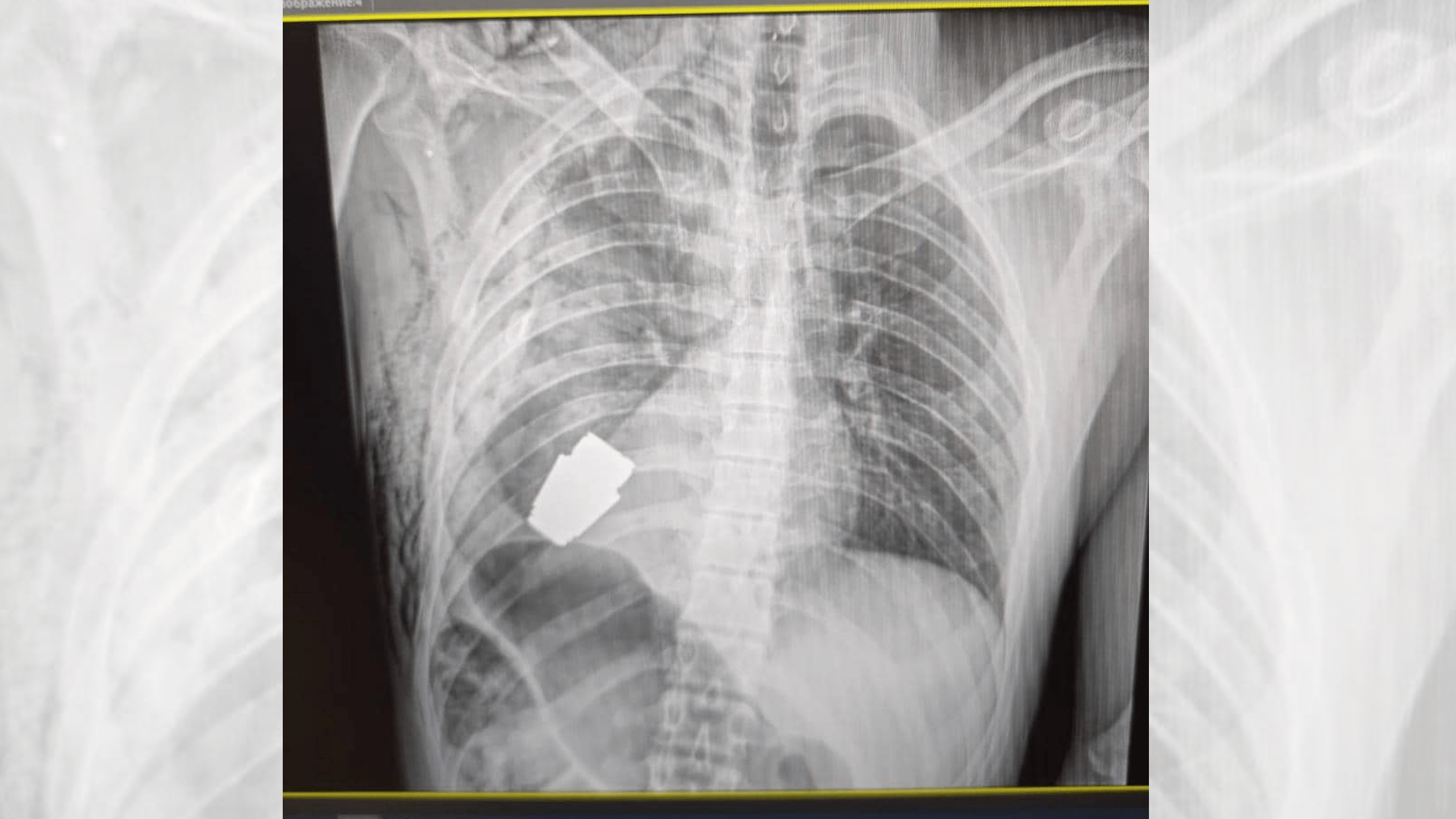 An X-ray image of the unexploded grenade, lodged just below the soldier�s heart.
