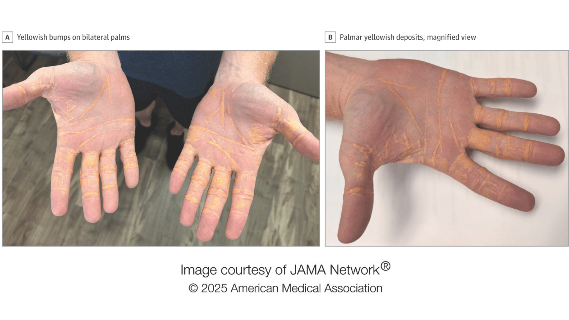 A figure from the case report showing two side-by-side images of the man�s hands with the yellow bumps on show.
