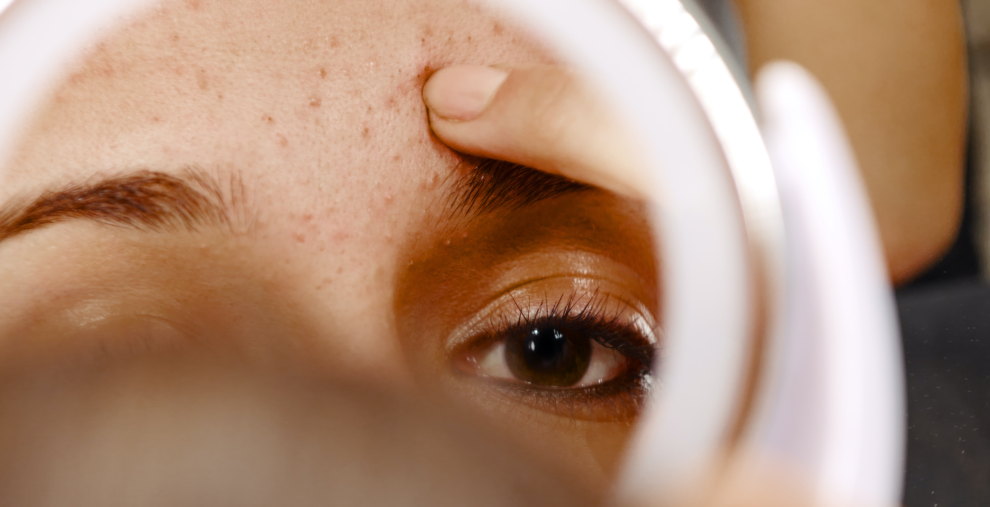 How to get rid of forehead acne, according to dermatologists Marie