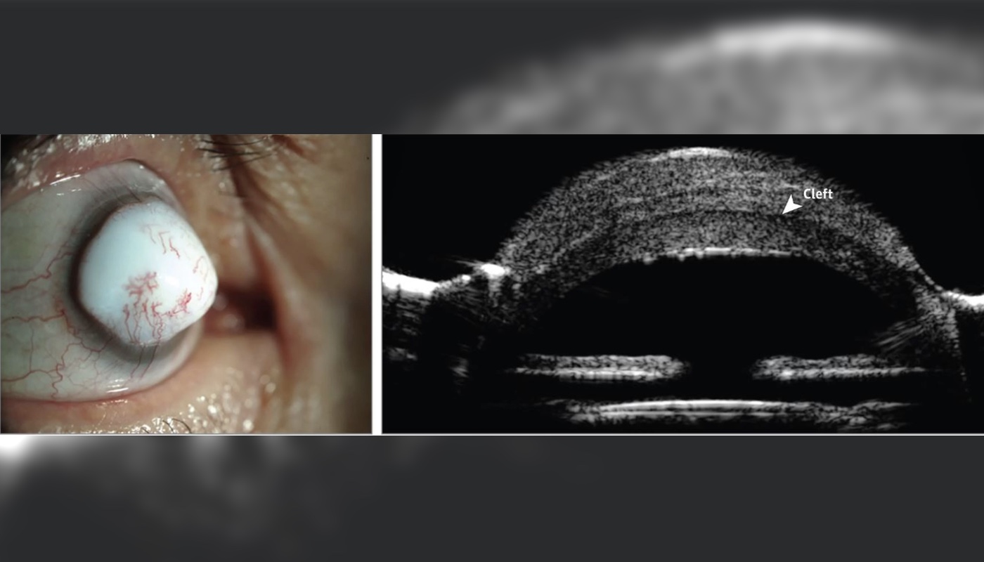 A man developed an extremely rare eye mass called a "corneal keloid" in his right eye. Above, images of the man�s eye (left), and a cross-section of the eye showing a "cleft" between the cornea and the lesion (right).