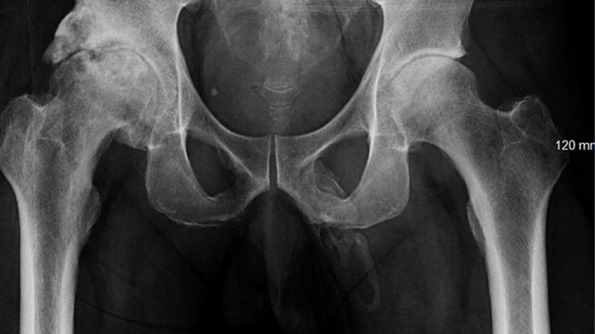 An X-ray of a man�s pelvis showing the faint outline of a bone inside his penis