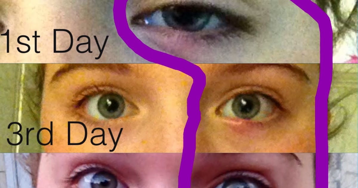 How Soon Can I Wear Makeup After A Stye Saubhaya Makeup