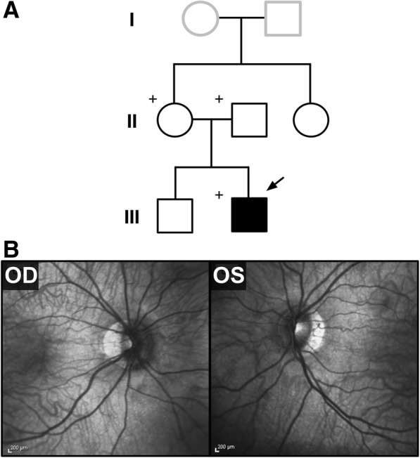 Missense mutation in SLIT2 associated with congenital myopia