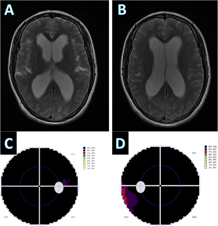 Intracranial hypertension due to spinal cord tumor misdiagnosed as