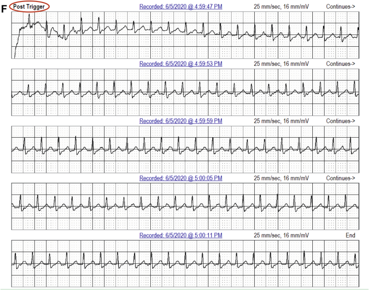 Continuous ECG monitoring versus mobile telemetry A comparison of
