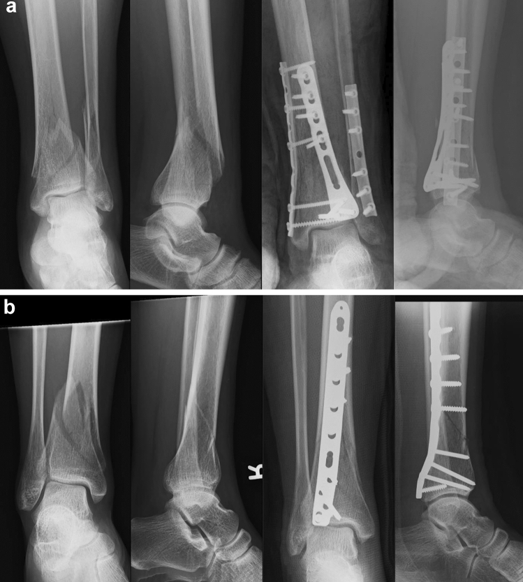 Posterolateral Plating of Distal Tibia Fractures Extending the Use of