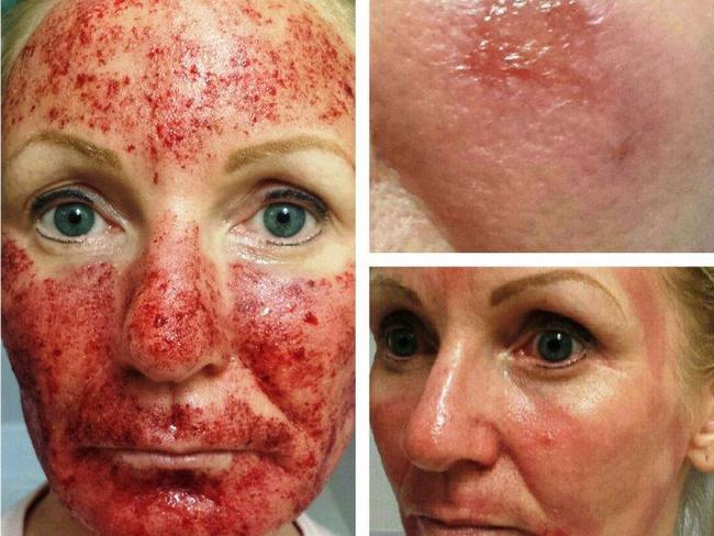 Laser treatment leaves woman bloodied and in pain Adelaide Now