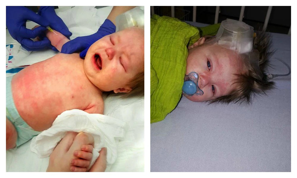 Meningitis rash covered baby's skin after just 24 hours Kidspot