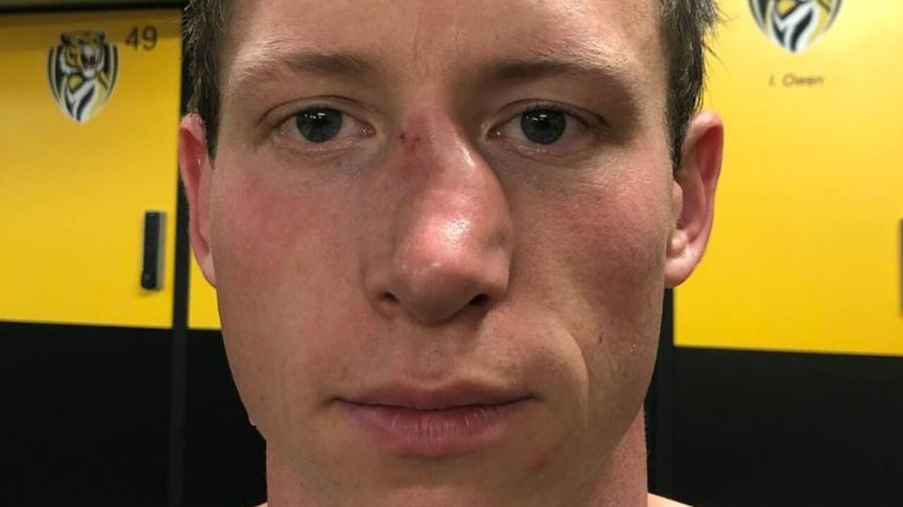AFL 2019, Tiger Dylan Grimes broken nose Fox Sports