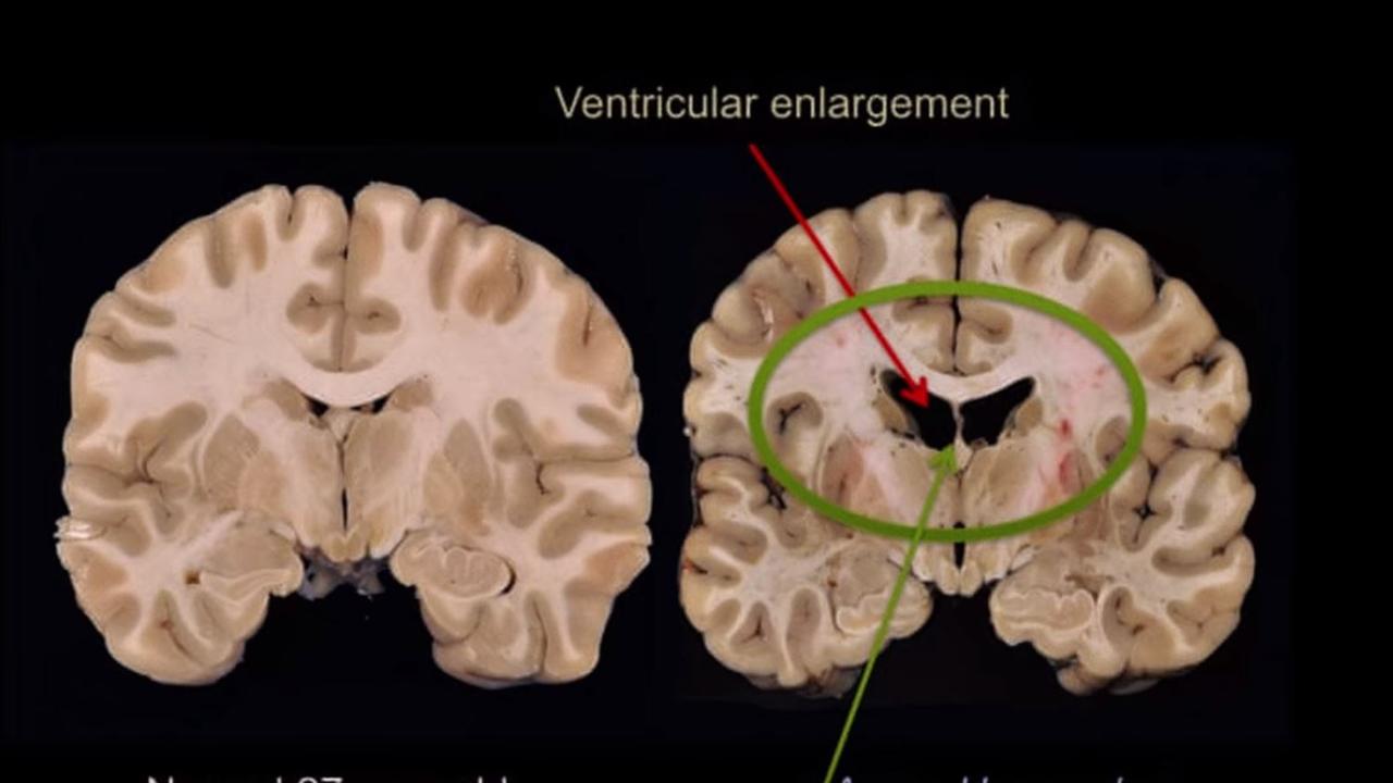 Aaron Hernandez Netflix documentary investigates CTE injury Adelaide Now
