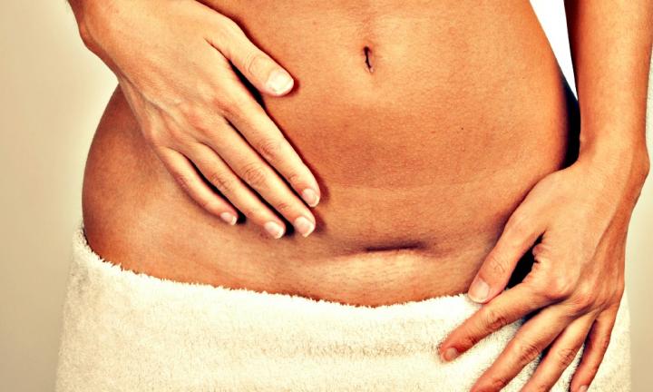 Ectopic pregnancy on a Csection scar A real life story Kidspot