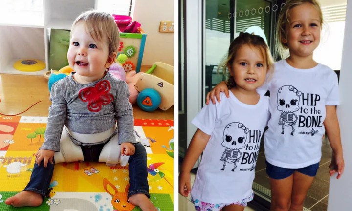 Hip dysplasia The signs you should look for in your baby