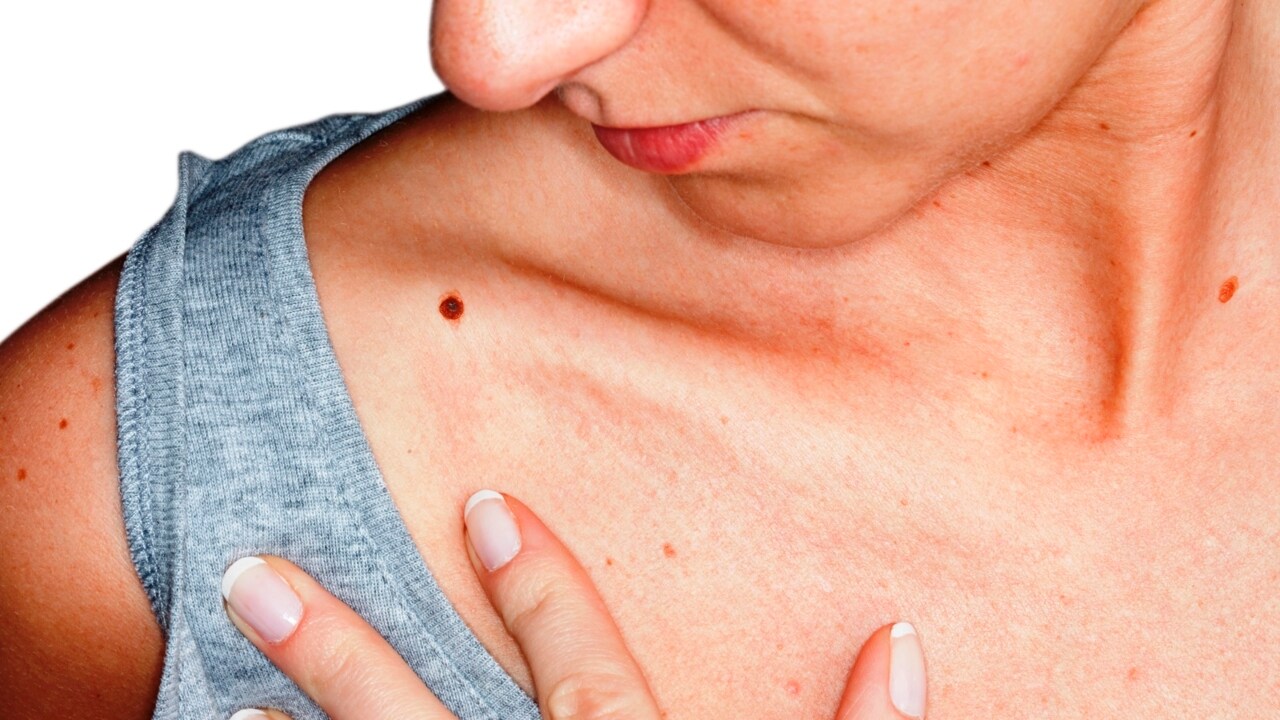 New melanoma blood test could speed up detection and save thousands