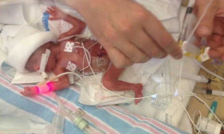 24 week premature baby's story of survival At 24 weeks Kidspot