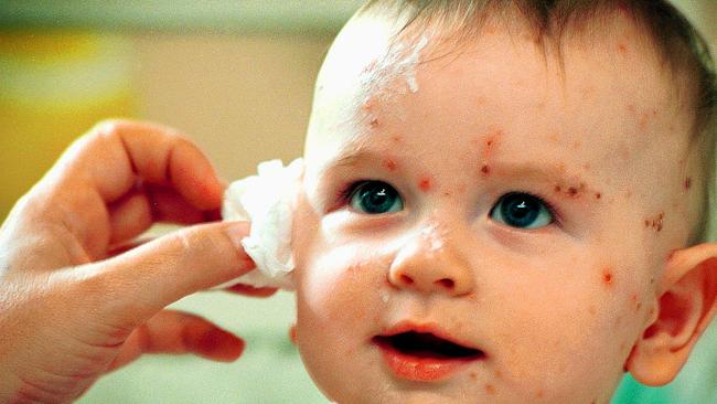 Chicken pox warning after case at Campbelltown primary school News Local