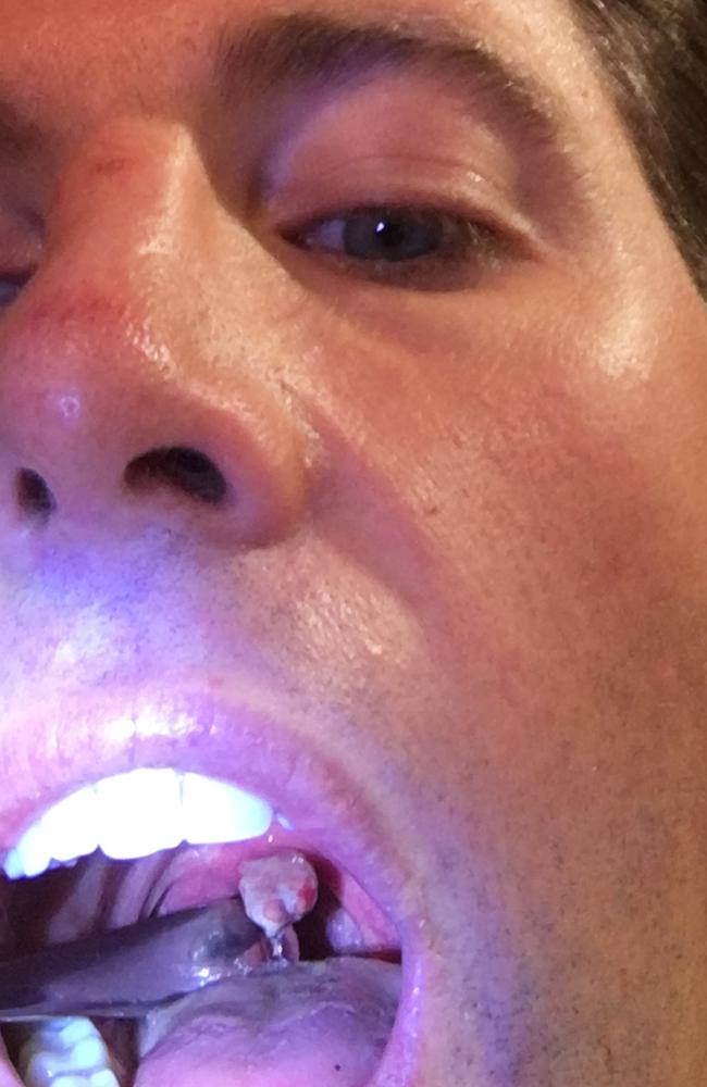 Grant Hackett admitted to private hospital for surgery to his throat